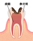 神経の虫歯