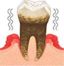 末期の歯周病