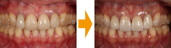 前歯4本をジルコニアオールセラミッククラウンにて修復の治療前と治療後の写真