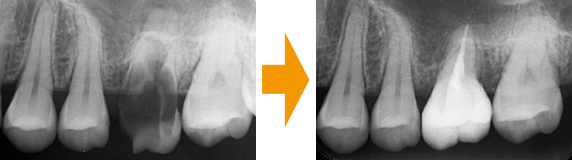 抜歯した部位に親知らずを移植する治療前と治療後の写真