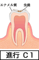 エナメル質の虫歯【C1】