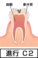 象牙質の虫歯【C2】