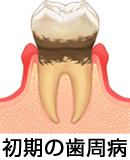 初期の歯周病