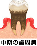 中期の歯周病